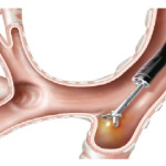 Endobronchial