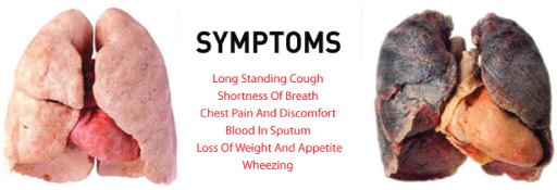 lung cancer